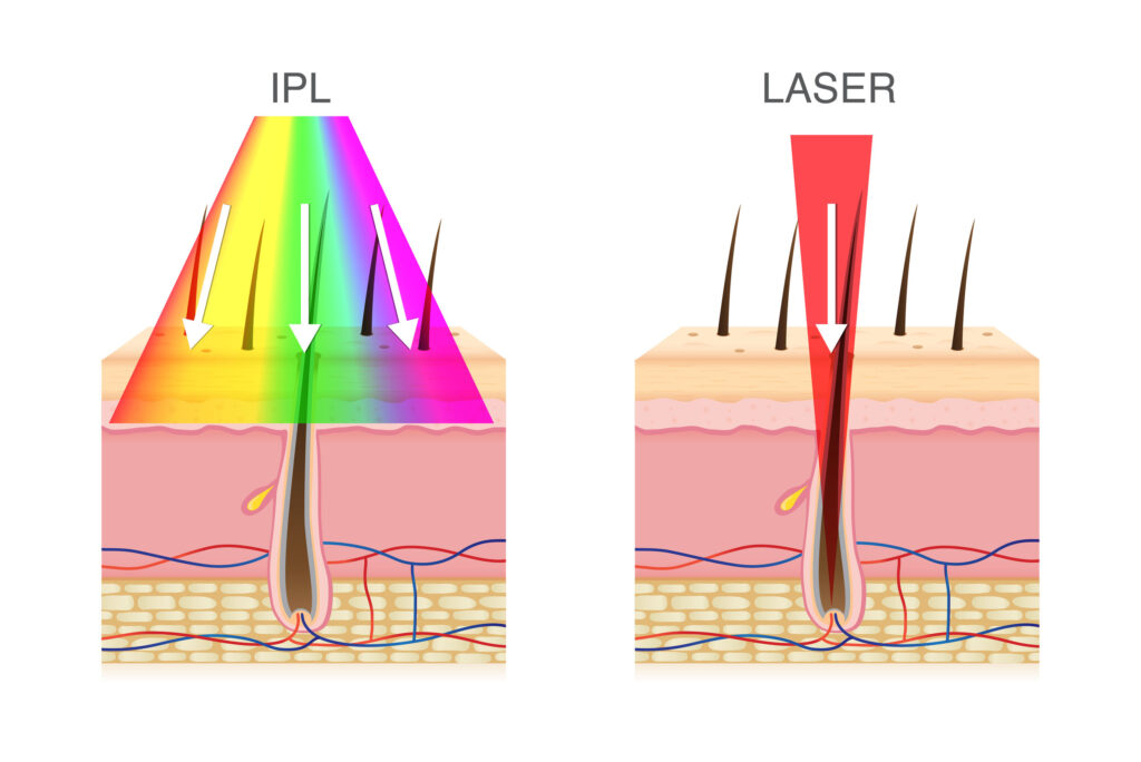 IPL and Laser Hair Removal Offer Permanent Hair Reduction