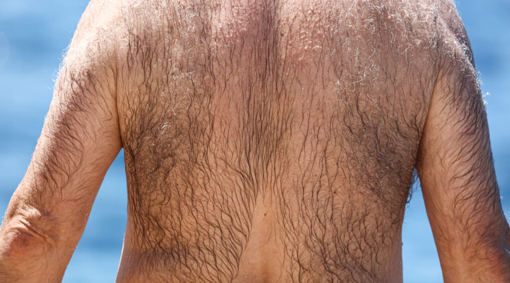 Back hair removal for men is a common body hair removal option.