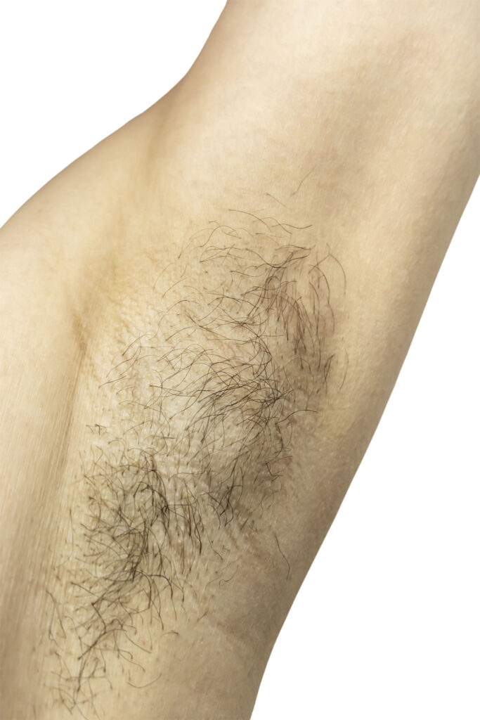 Does Laser Hair Removal Hurt?