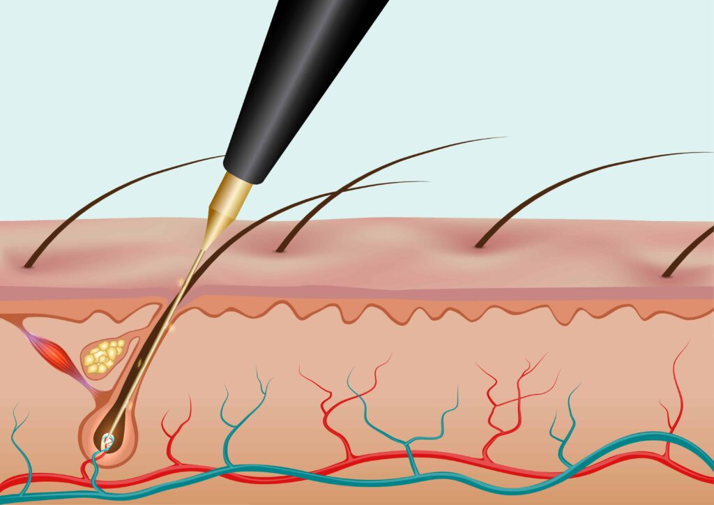 Electrolysis bikini hair removal process