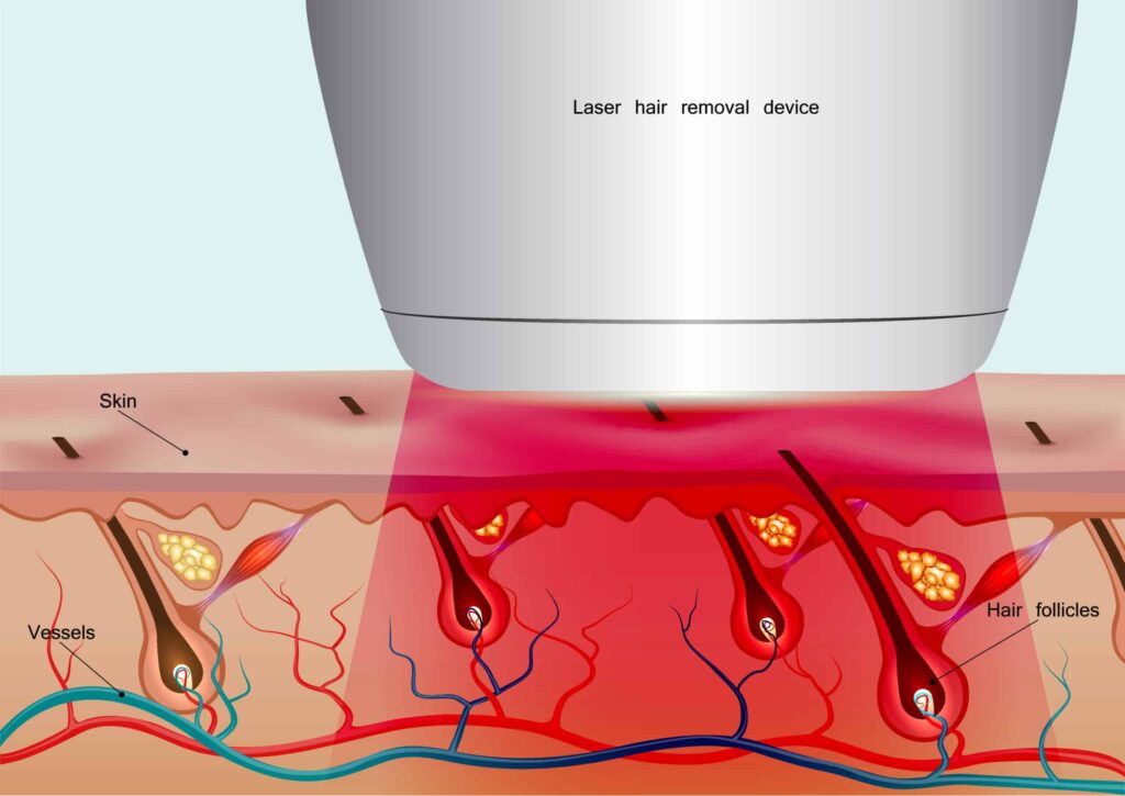 Laser hair removal versus electrolysis hair removal