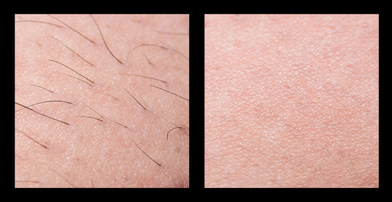 Before and after laser hair reduction