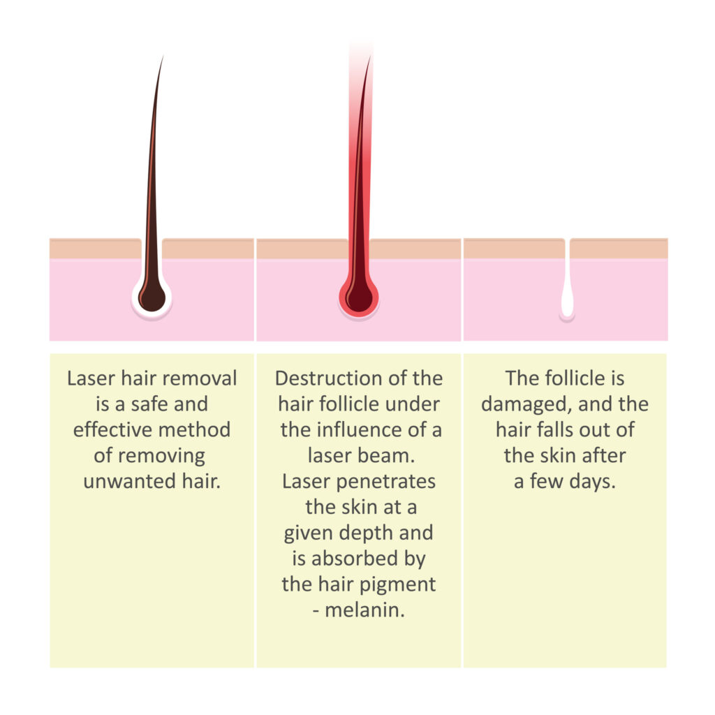 Does Hair Grow Back After Laser Hair Removal?