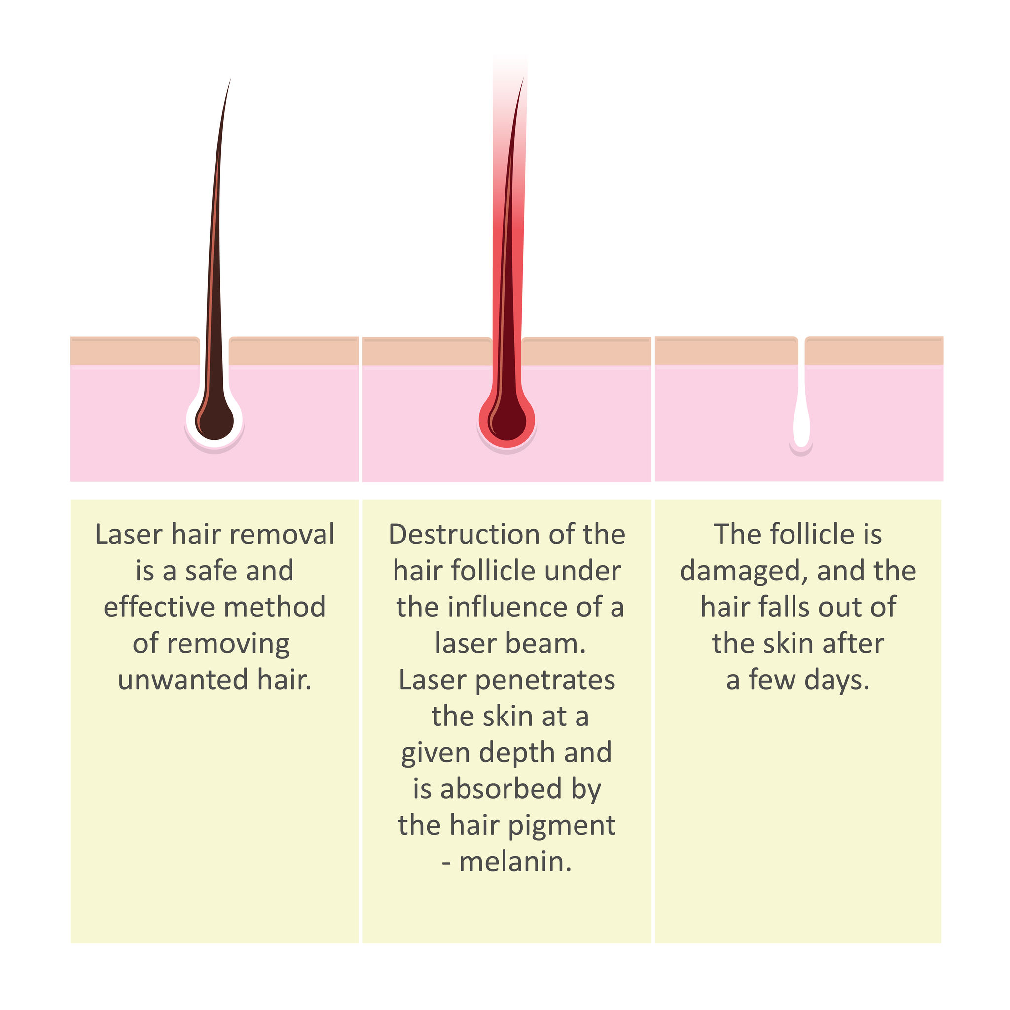 How Long Does It Take Hair To Fall Out After A Laser Hair Removal Treatment?