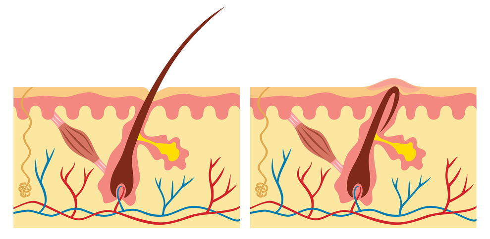 Ingrown hairs may temporarily occur after laser hair removal.