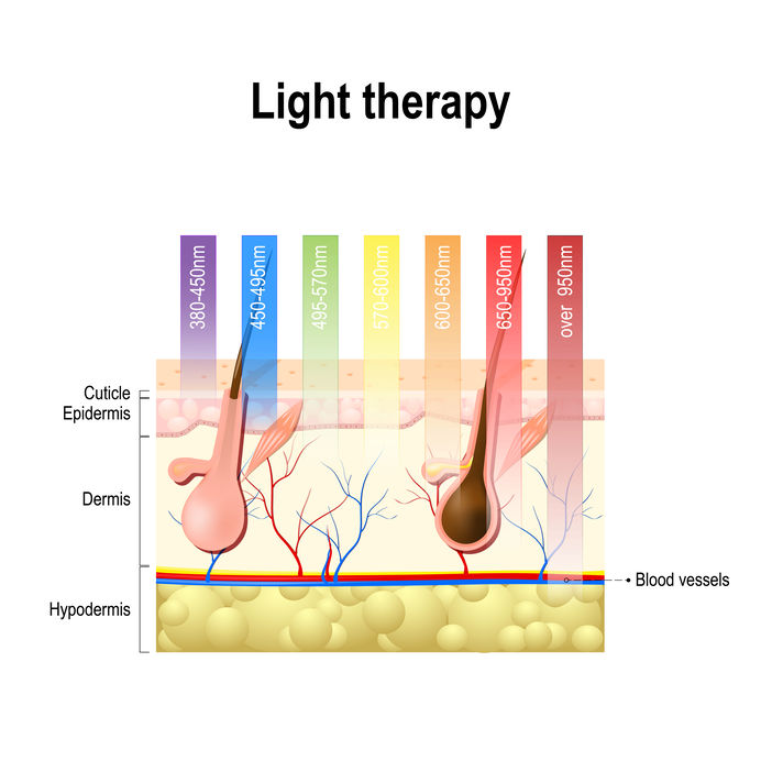 Nd:YAG laser for hair removal