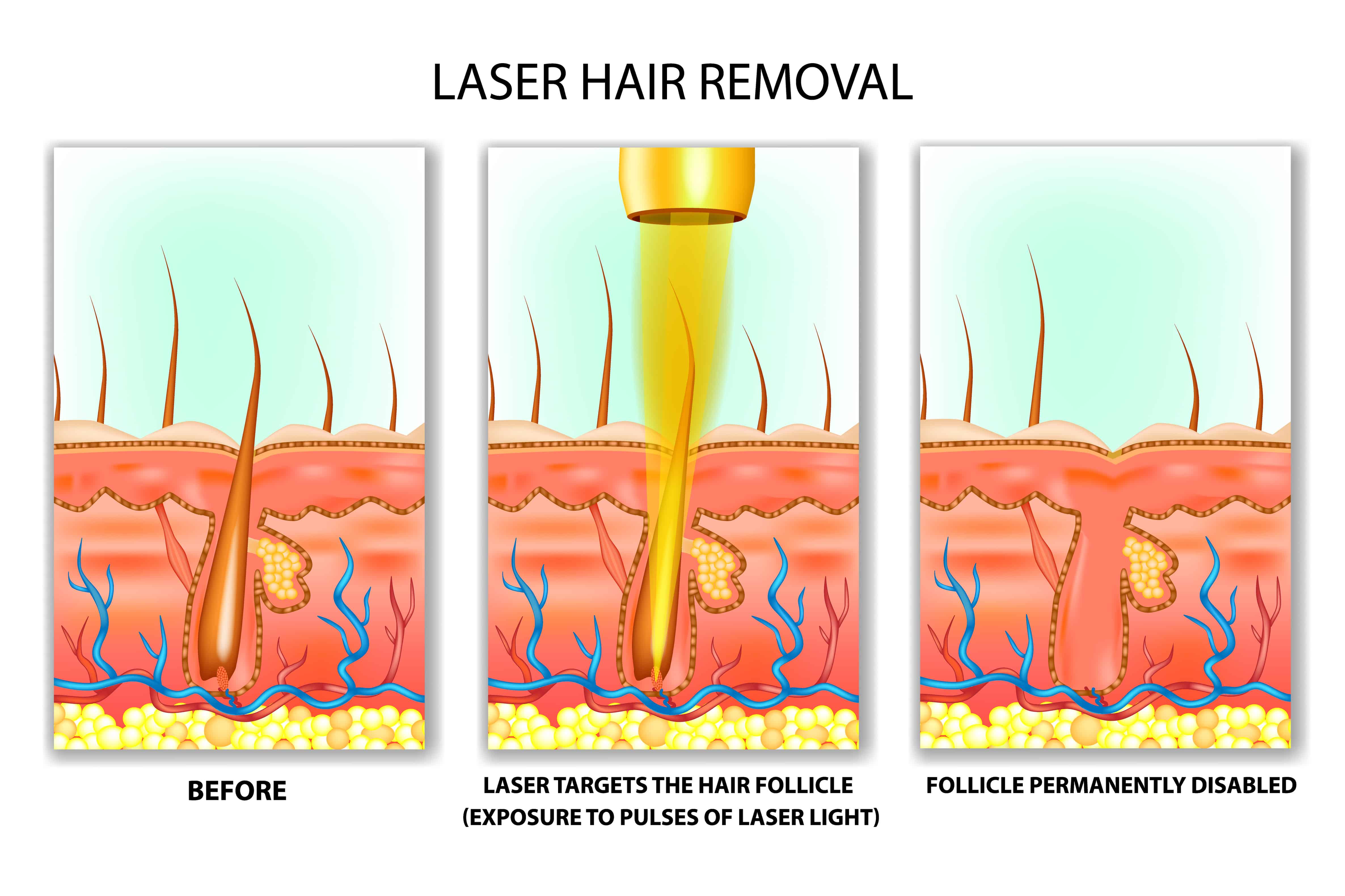 Hair begins to fall out several days following laser hair removal